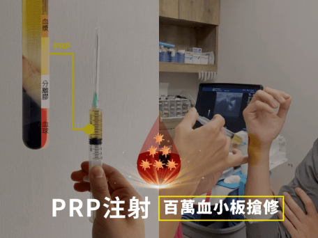 血小板注射增生治療