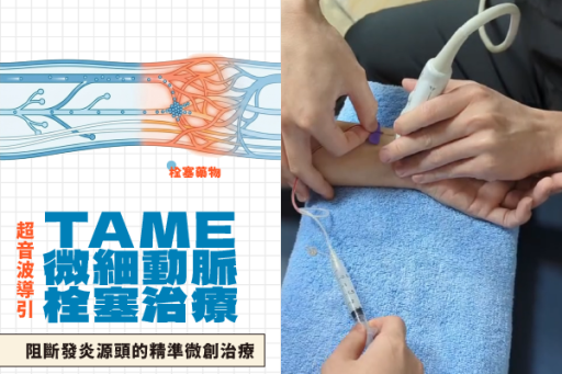 超音波導引微細動脈栓塞治療術TAME