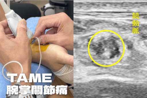 腕掌關節TAME治療