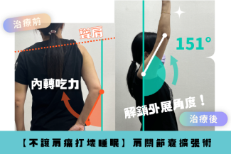 肩膀角度受限肩關節擴張術