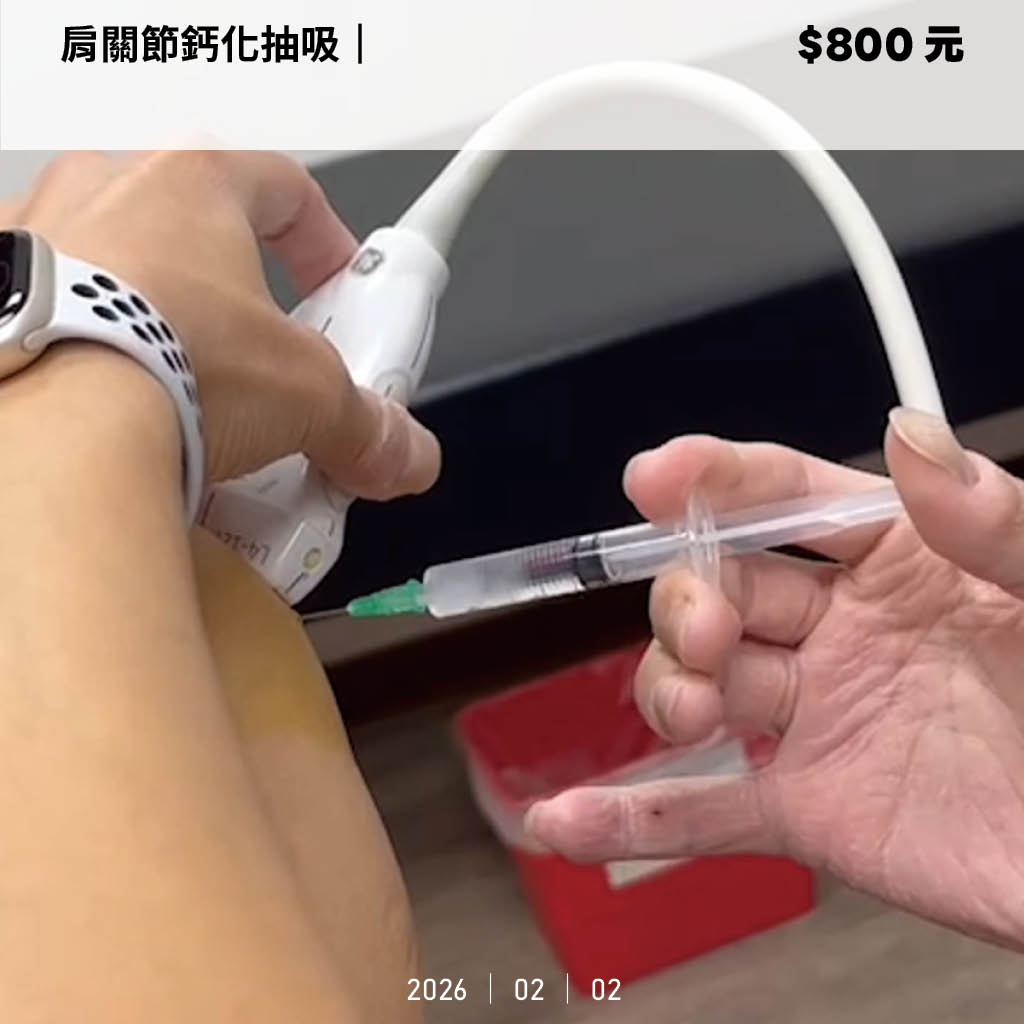 肩膀抽鈣化費用