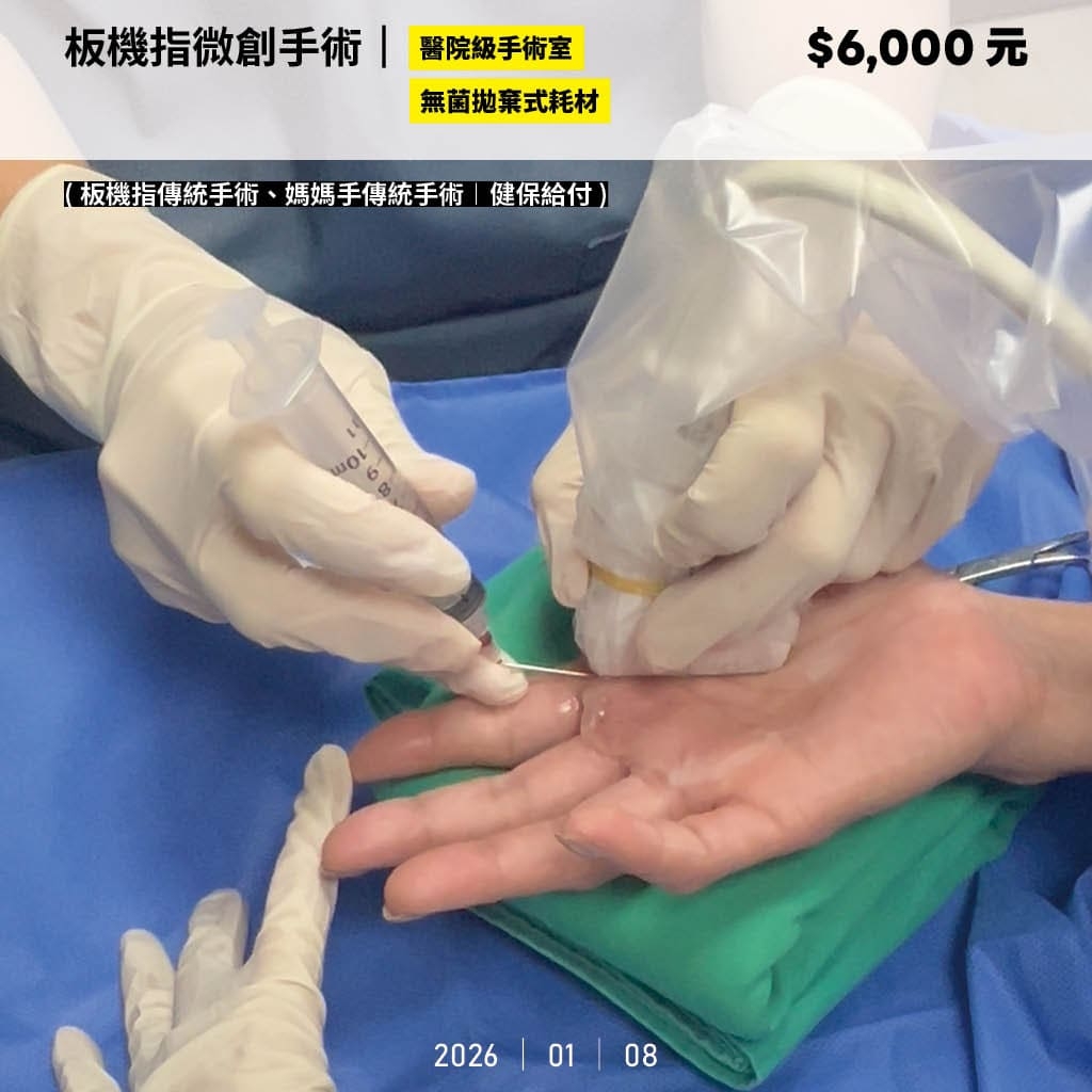 板機指微創費用